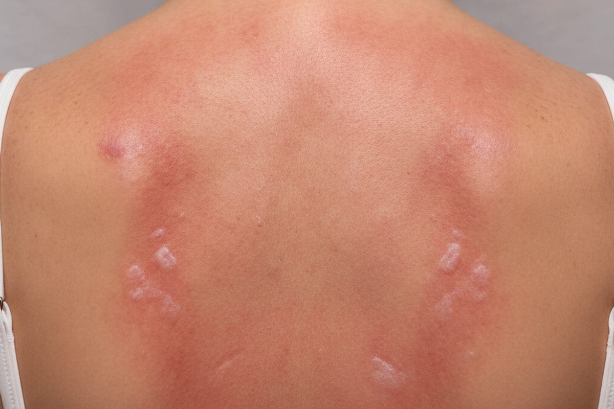 sunburn — shown on a beach holiday